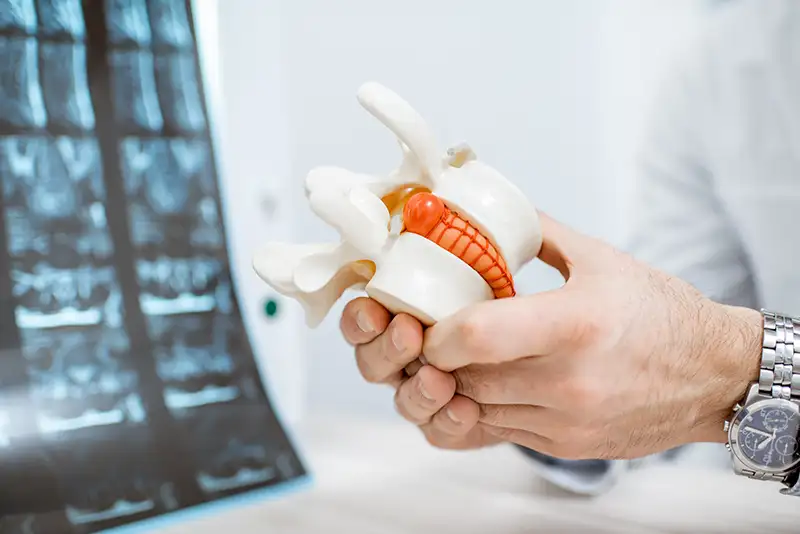 Spine Model Showing Herniated Disc Compression