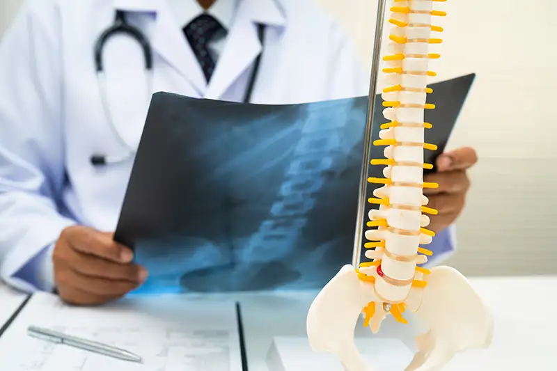 Physician holding spinal model showing herniated disc during evaluation